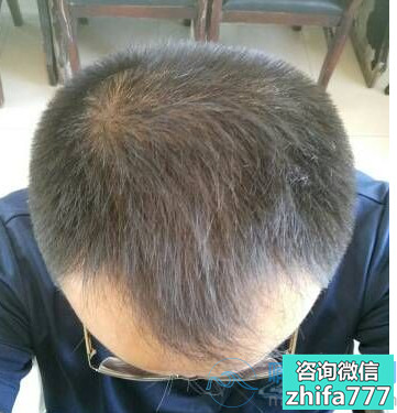 南宁贞韩植发稀少加密种植案例分享