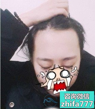 上海时光发际线种植都夸我变好看啦