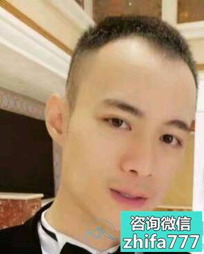 成都艺美汇发际线种植案例分享