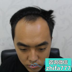 南京大麦发际线种植，一年的最终效果很棒