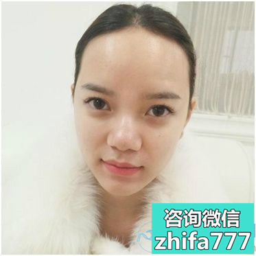 杭州新生发际线种植，让我变漂亮啦