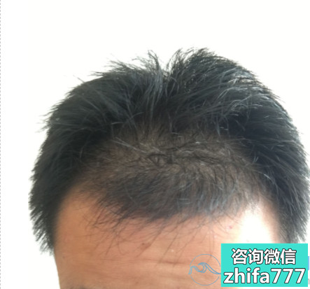 厦门碧莲盛发际线种植术后效果分享
