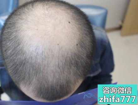 南昌碧莲盛秃顶植发案例分享
