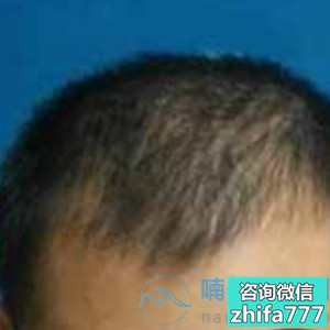 深圳新生稀少加密种植非常满意