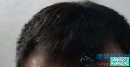 南京连天美发际线种植案例分享