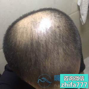 长沙协雅秃顶植发效果非常满意