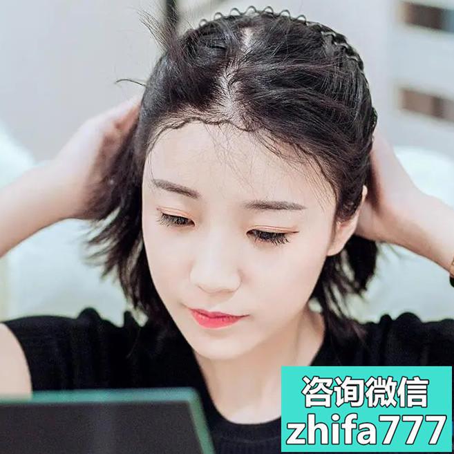 北京壹加壹发际线种植恢复得特别好