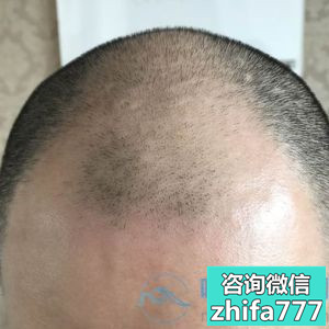 广州大麦稀少加密种植，头发密度很好