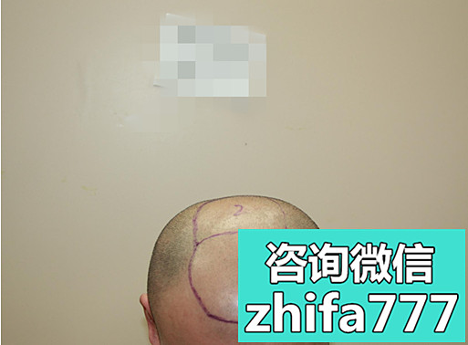 哈尔滨植发：煤矿工植发案例