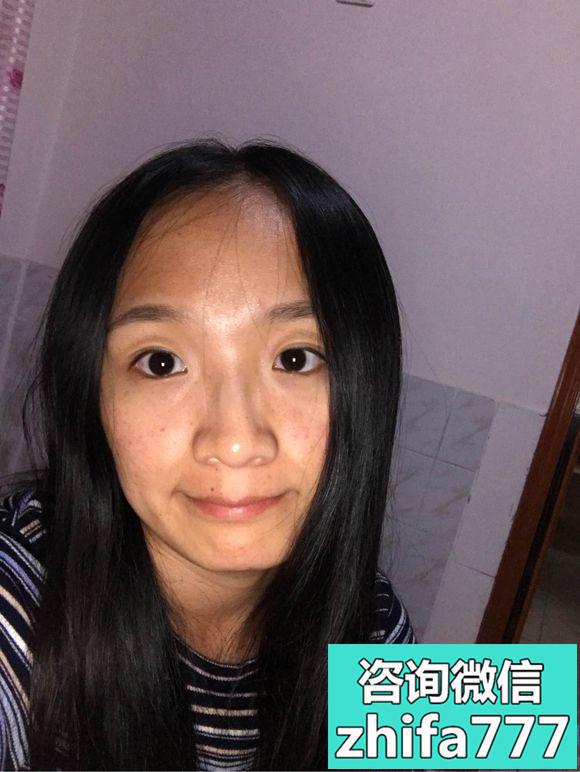 西安熙朵发际线种植成活率杆杆的