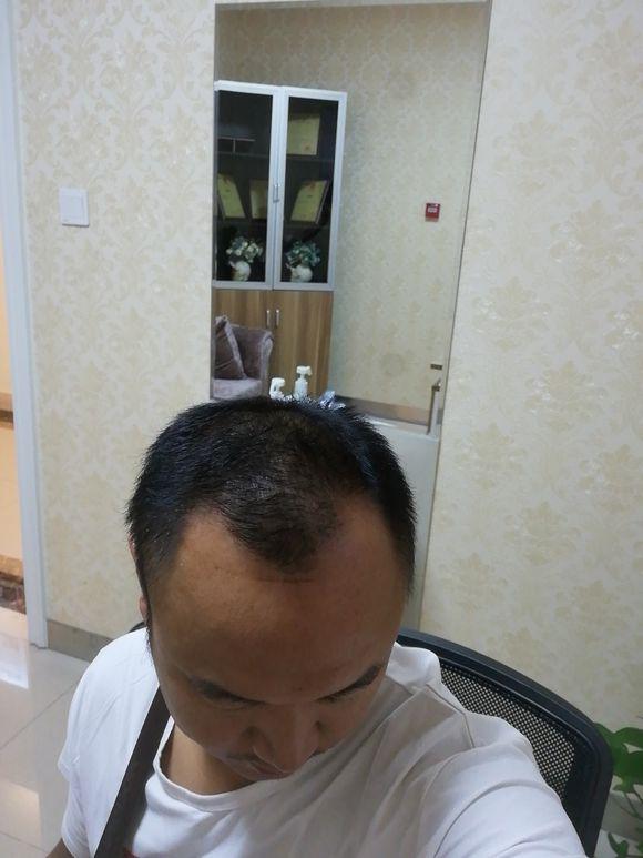 不想要这样的我要植发