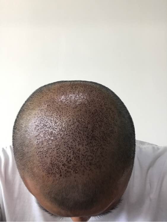 现在的我已经灰心了植发吧