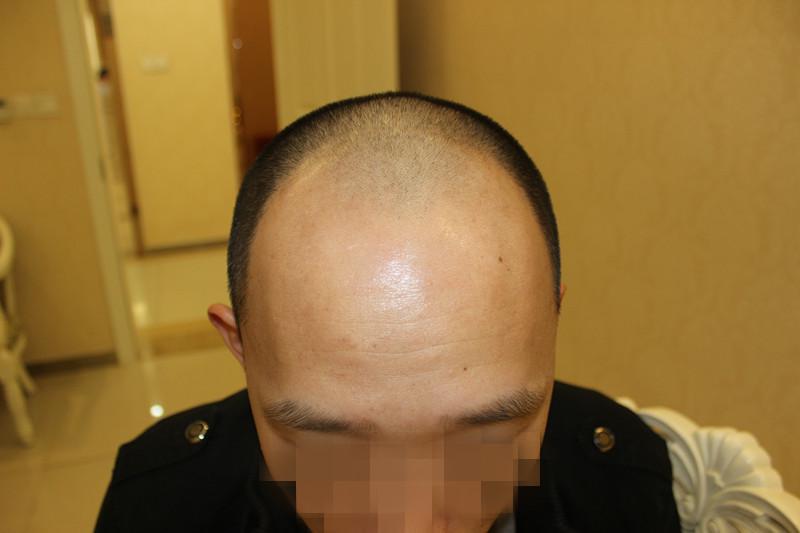 这种脱发真的不好治