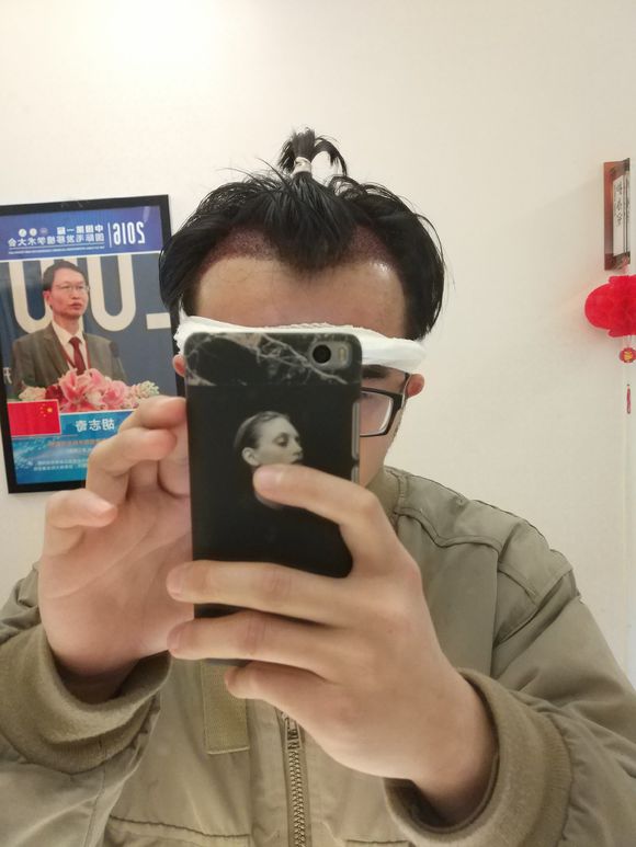 基因导致的脱发怎么解决