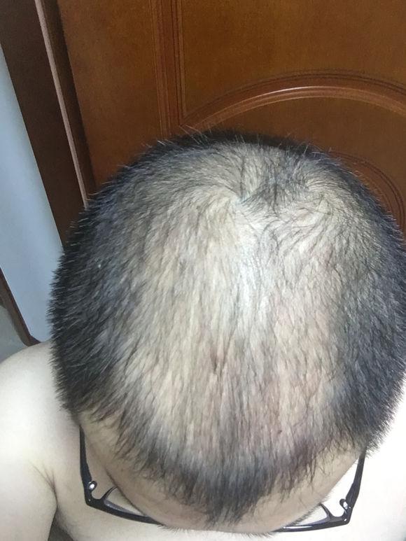 形象不给力该怎么办植发吧