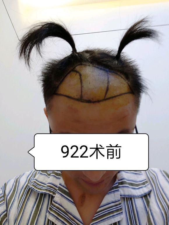 遗传性的脱发严重怎么办