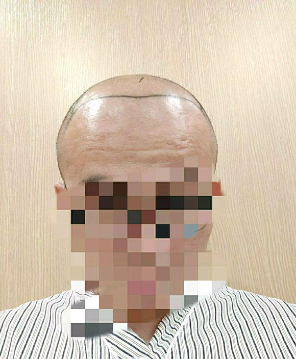 头发变少的历程