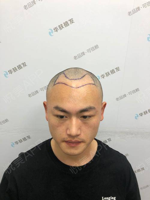 对于植发等在恢复一些给同胞们说一下植发值不值得去做