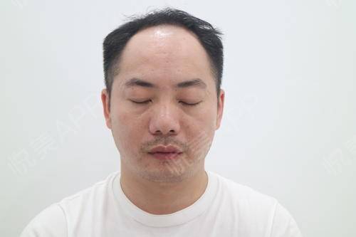 种植完头发第20天啦给大家看看我头发的生长情况