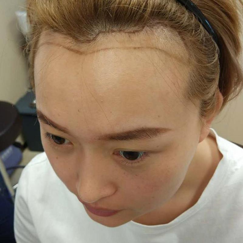 丑小鸭变白天鹅就差一个发际线