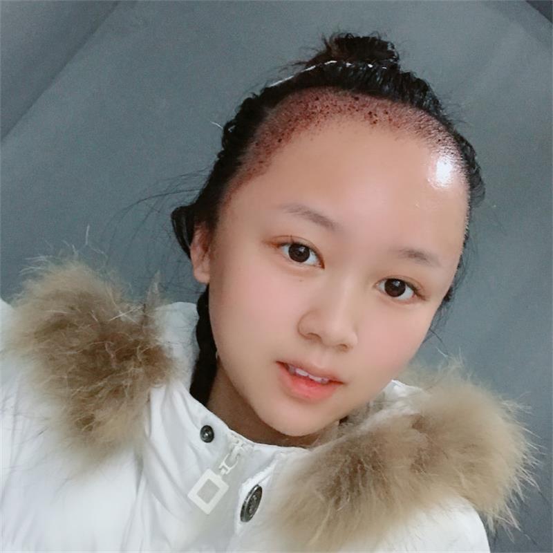植发让我重回颜值巅峰