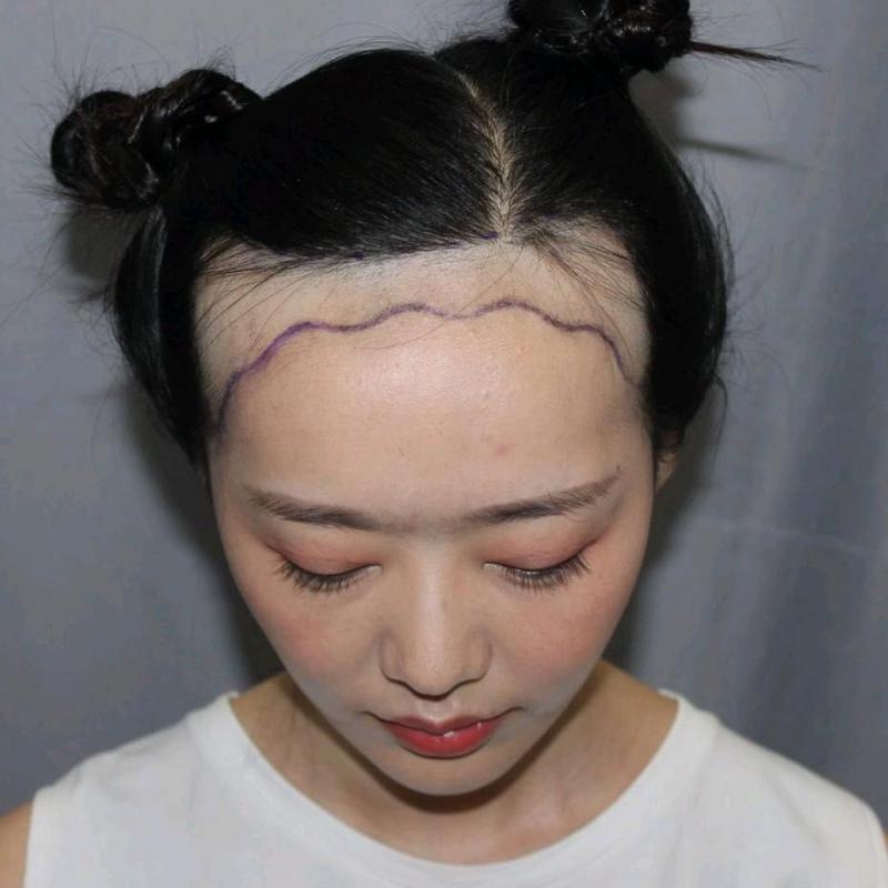 脱发秃女子为了这3厘米我愿意付出所有