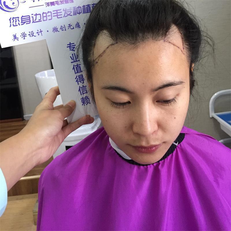 今天过后，不再秃头！