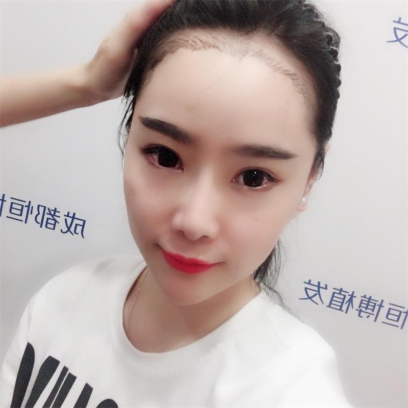 广州发际线种植怎么样