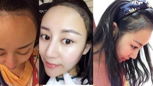 发际线种植恢复效果分享回归精致小脸