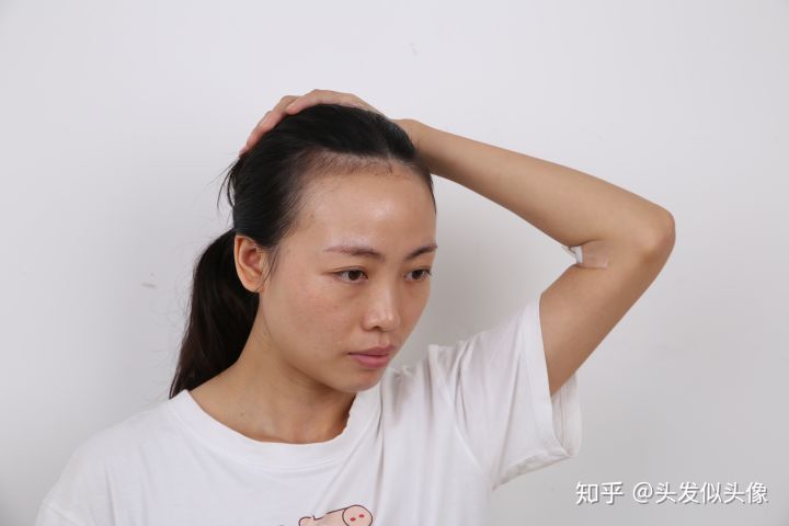 记录发际线种植后的变化（持续更新）