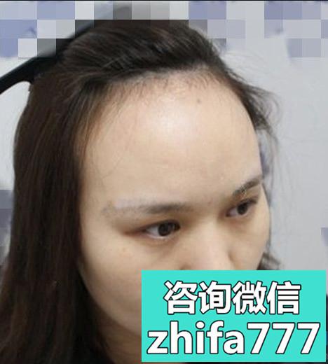 苏州美贝尔发际线种植术后分享来啦