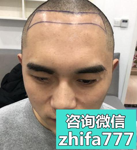 锦州斯美诺发际线种植，成活率很高