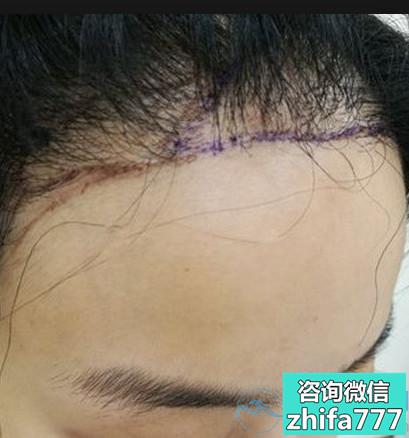 襄阳韩美发际线种植成活率很高