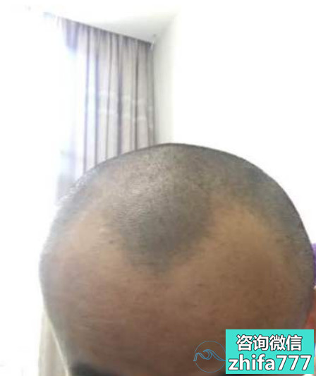 合肥丽人发际线种植，头发明显比以前不同了