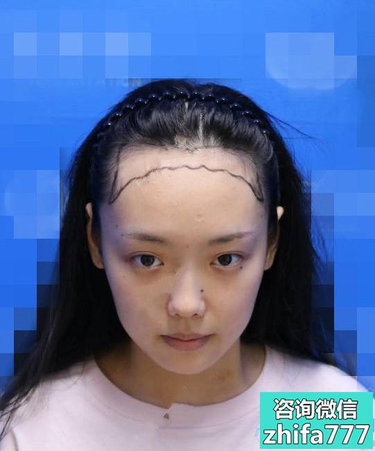 柳州贞韩发际线种植，看上去浓密自然了