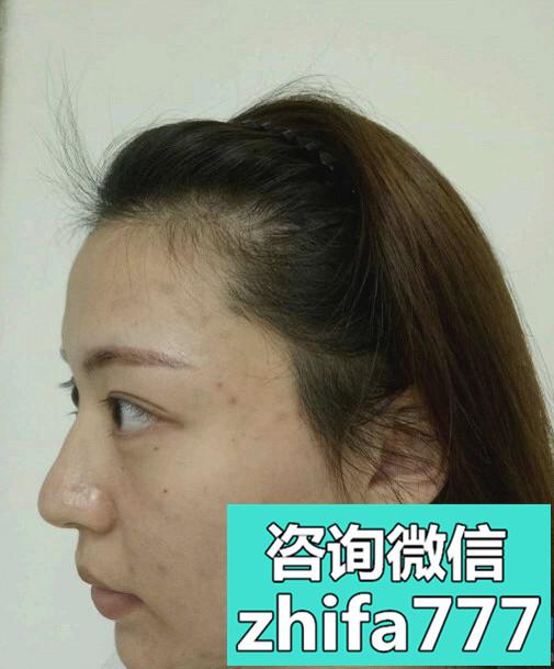 合肥源森发际线种植，很显脸小
