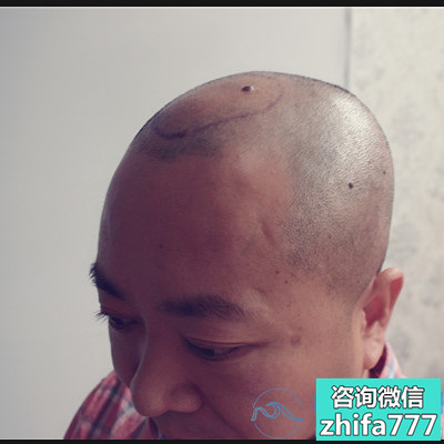 慈溪新生头顶加密种植，都说我变年轻了