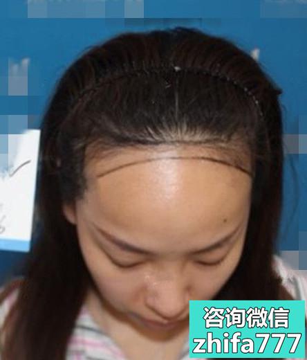 无锡坤如玛丽发际线种植，和原生发融合的非常好