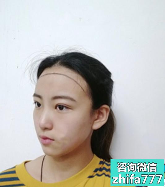 福州格莱美发际线种植非常自然，很修饰脸型