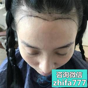 南京新秀植发，效果棒棒的