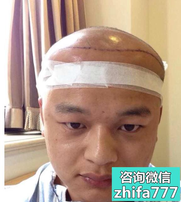 合肥韩美发际线种植，术后很满意