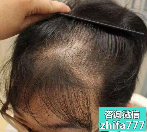 扬州新生头顶加密种植，成活率高