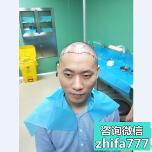 广州碧莲盛植发，解决头发困扰不是梦