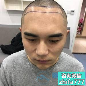 杭州新生发际线种植，有头发的感觉真的棒