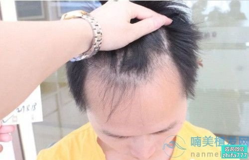 成都新生发际线种植，头发长势还不错