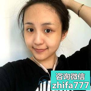 温州建国发际线种植，长势挺不错的还很自然
