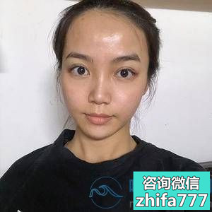 南京新生发际线种植，解决大额头不是梦