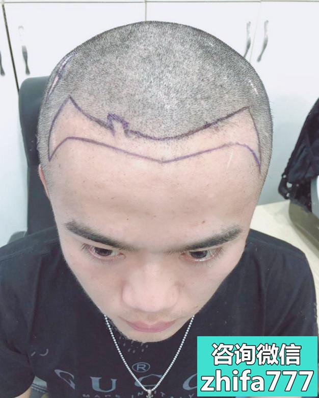 上海新生发际线种植，术后浓密了不少