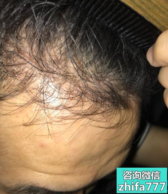 济南瑞丽诗稀少加密种植 发际线种植是我想要的效果