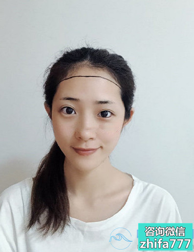 武汉同济发际线种植长得很好